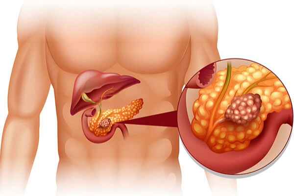 Living with Chronic Pancreatitis: Understanding, Managing, and Thriving