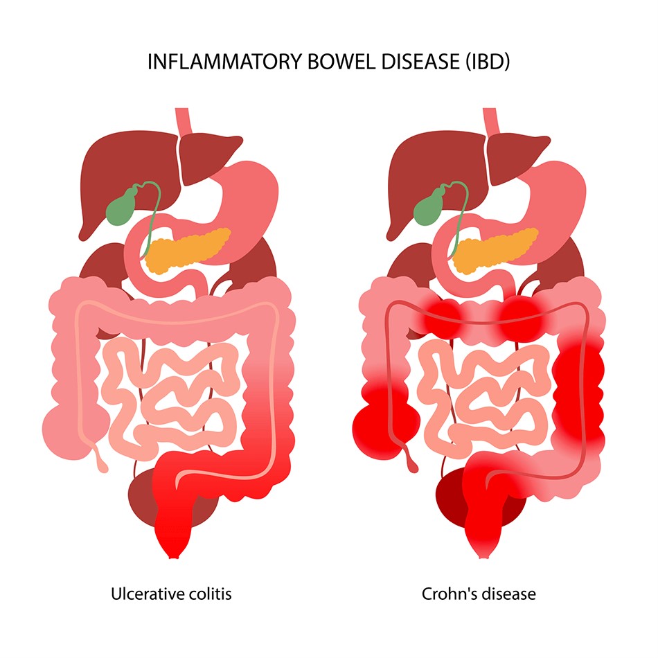 Managing Inflammatory Bowel Disease: Crohn's Disease and Ulcerative Colitis